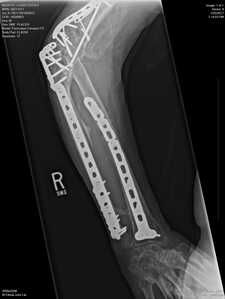 Right elbow 3 Right elbow 3